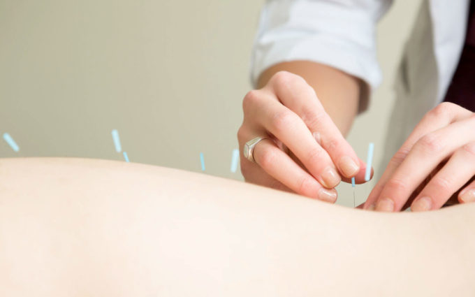 Acupuncture for IVF