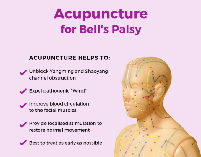 Acupuncture for Bell's Palsy
