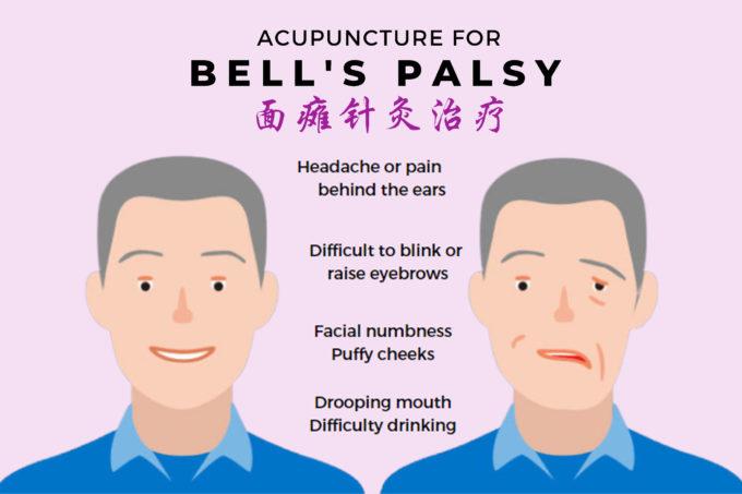 Post image of Acupuncture for Bell’s Palsy at NUH Medical Centre