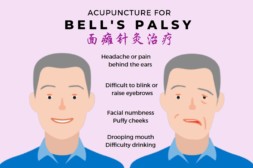 News image of Acupuncture for Bell’s Palsy at NUH Medical Centre