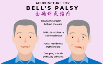 Post image of Acupuncture for Bell’s Palsy at NUH Medical Centre