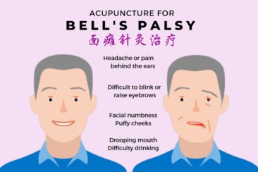 News Image Acupuncture for Bell’s Palsy at NUH Medical Centre