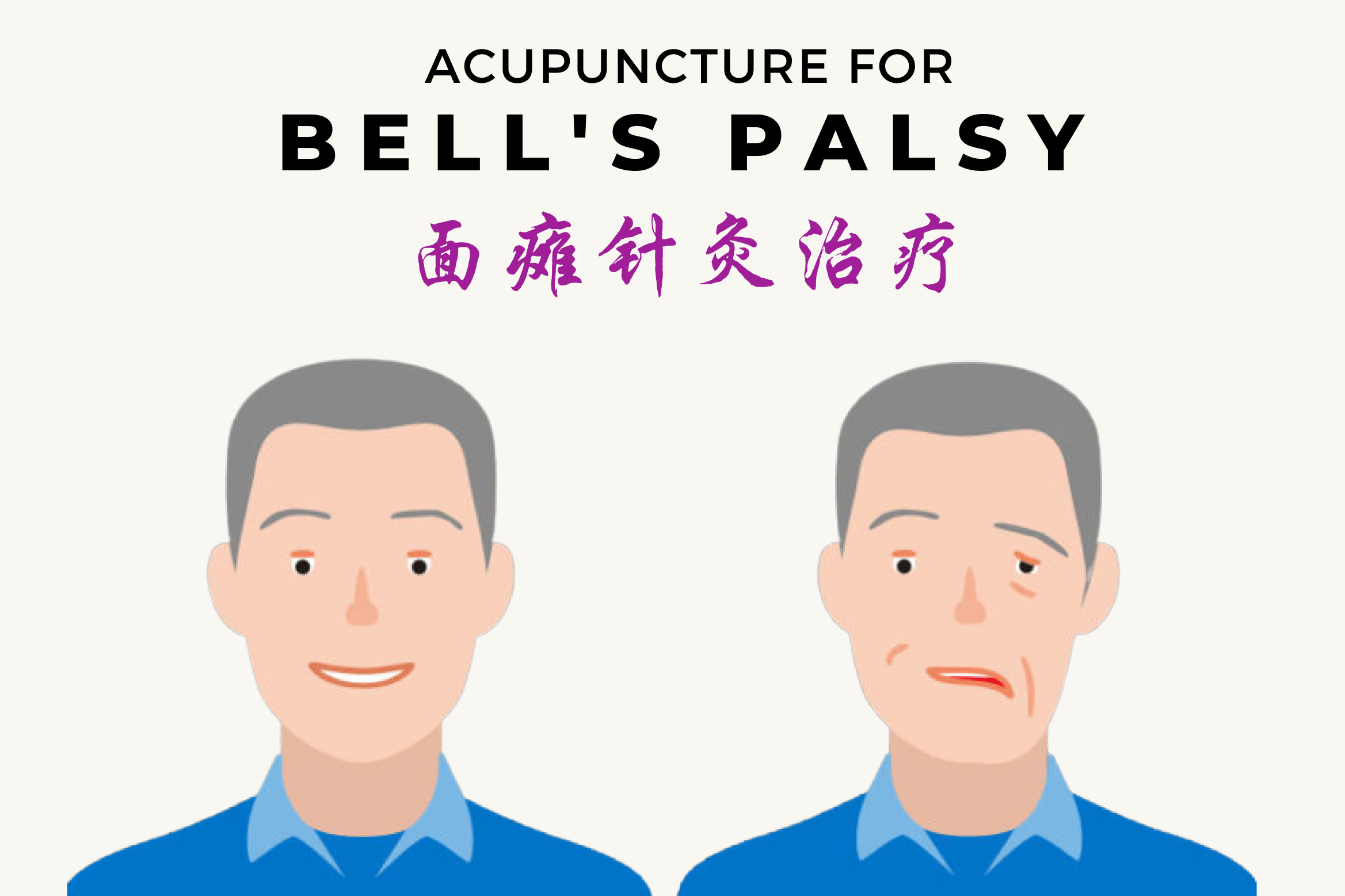Blog image for TCM Acupuncture Treatment for Bell’s Palsy