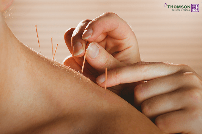 Acupuncture a traditional chinese medicine in singapore