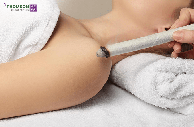 Moxibustion by Thomson Chinese Medicine Therapy
