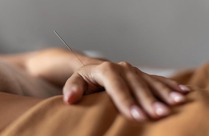 Acupuncture has psychological benefits while dry needling centres on physical well-being