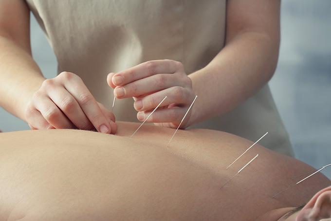 Acupuncture vs Dry Needling: What Are the Differences