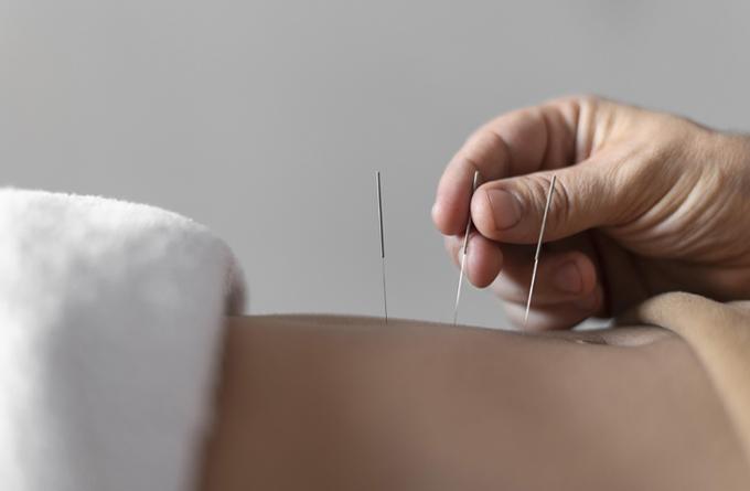 How TCM Treatments Help in Relieving Eczema Symptoms-acupuncture singapore