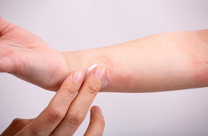 Keep your skin moisturised-TCM Eczema singapore