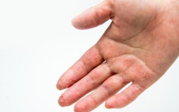 Blog image for TCM’s Role in Relieving Eczema Symptoms