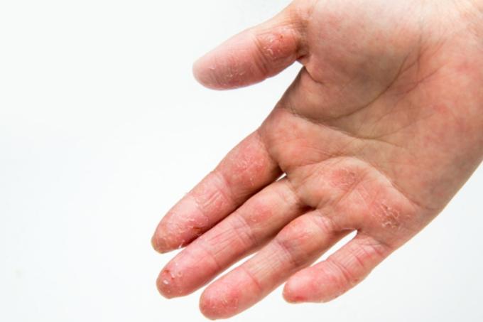TCM Role in Relieving Eczema Symptoms