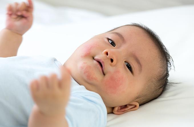 TCM Tips for Paediatric Eczema-TCM Eczema singapore